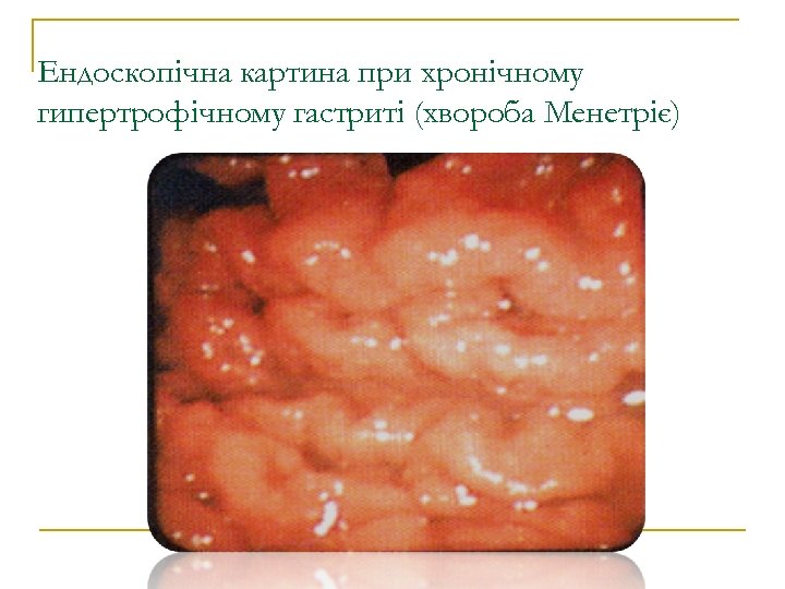 Ендоскопічна картина при хронічному гипертрофічному гастриті (хвороба Менетріє) 