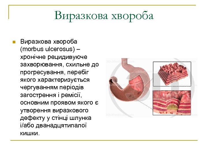 Виразкова хвороба n Виразкова хвороба (morbus ulcerosus) – хронічне рецидивуюче захворювання, схильне до прогресування,