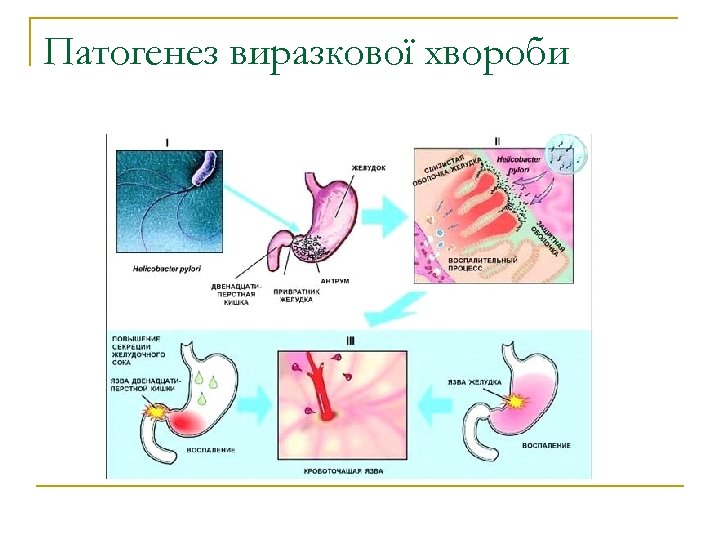 Патогенез виразкової хвороби 