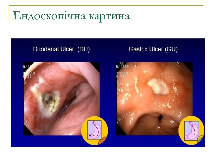 Ендоскопічна картина 