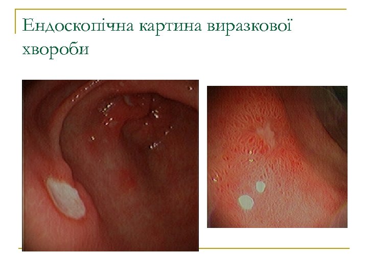 Ендоскопічна картина виразкової хвороби 