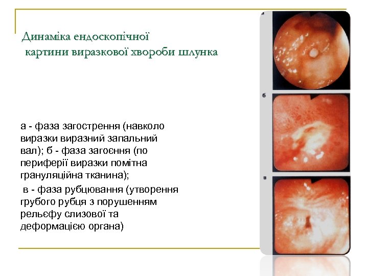 Динаміка ендоскопічної картини виразкової хвороби шлунка а - фаза загострення (навколо виразки виразний запальний