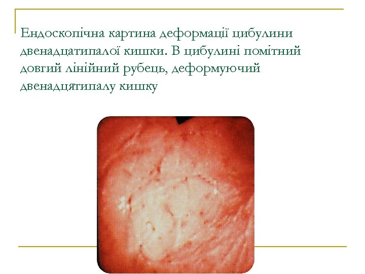 Ендоскопічна картина деформації цибулини двенадцатипалої кишки. В цибулині помітний довгий лінійний рубець, деформуючий двенадцятипалу