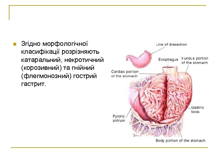 n Згідно морфологічної класифікації розрізняють катаральний, некротичний (корозивний) та гнійний (флегмонозний) гострий гастрит. 