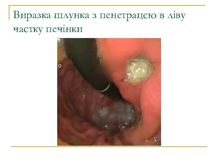 Виразка шлунка з пенетрацєю в ліву частку печінки 