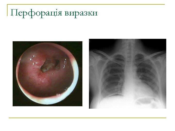 Перфорація виразки 