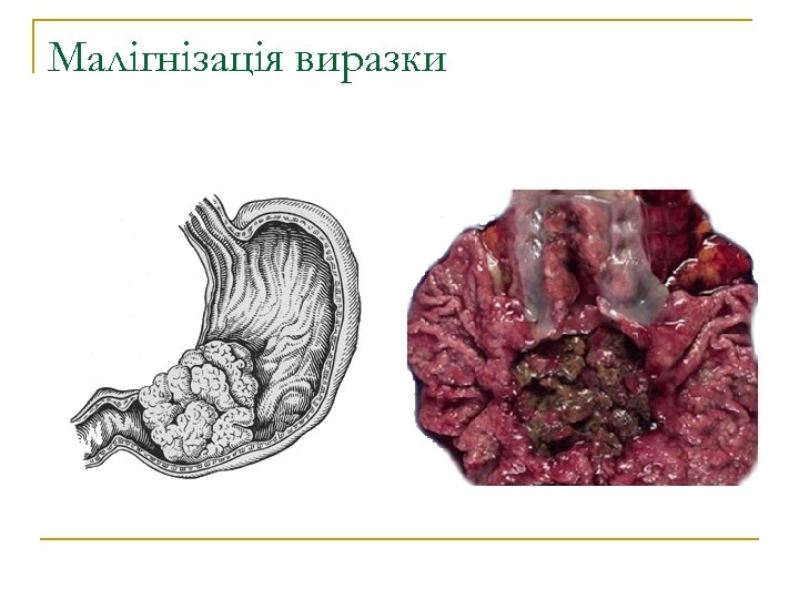 Малігнізація виразки 