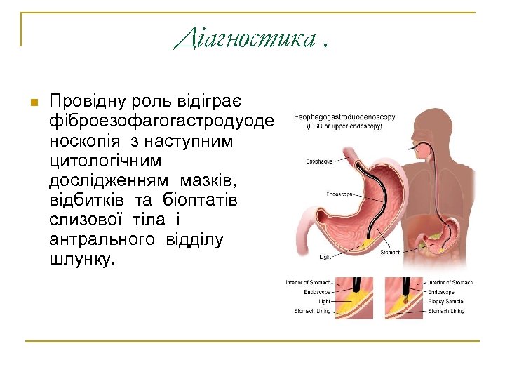 Діагностика. n Провідну роль відіграє фіброезофагогастродуоде носкопія з наступним цитологічним дослідженням мазків, відбитків та