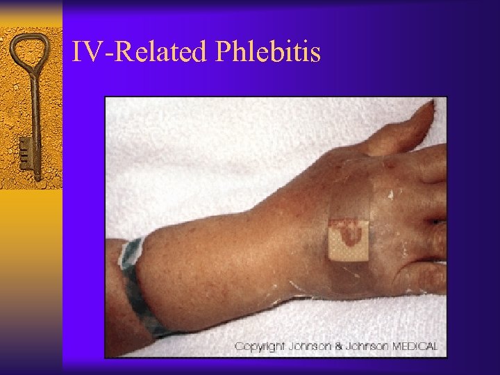 IV-Related Phlebitis 