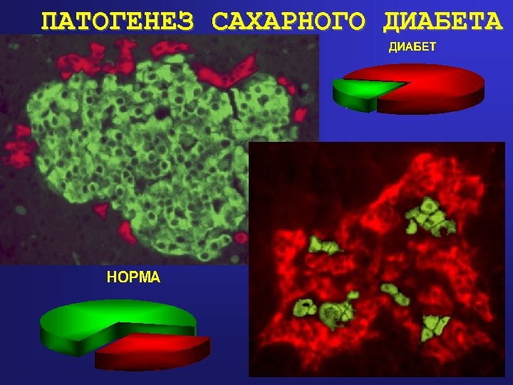 ПАТОГЕНЕЗ САХАРНОГО ДИАБЕТА 