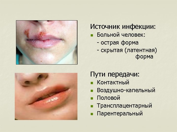 Источник инфекции: n Больной человек: - острая форма - скрытая (латентная) форма Пути передачи: