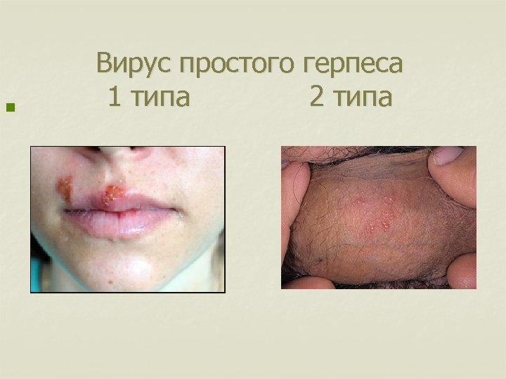 n Вирус простого герпеса 1 типа 2 типа 