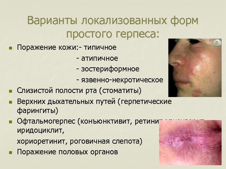 Варианты локализованных форм простого герпеса: n n n Поражение кожи: - типичное - атипичное