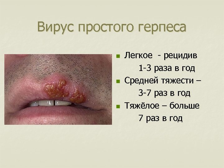 Вирус простого герпеса n n n Легкое - рецидив 1 -3 раза в год