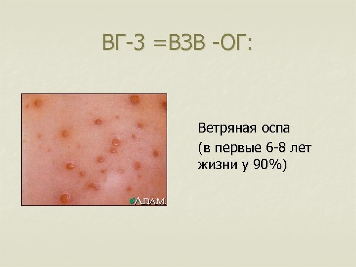 ВГ-3 =ВЗВ -ОГ: Ветряная оспа (в первые 6 -8 лет жизни у 90%) 