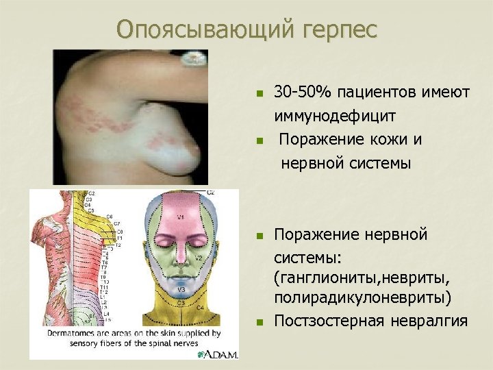 Опоясывающий герпес n n 30 -50% пациентов имеют иммунодефицит Поражение кожи и нервной системы