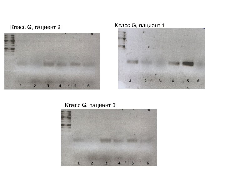 Класс G, пациент 2 Класс G, пациент 1 Класс G, пациент 3 