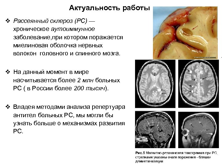 Актуальность работы v Рассеянный склероз (РС) — хроническое аутоиммунное заболевание, при котором поражается миелиновая