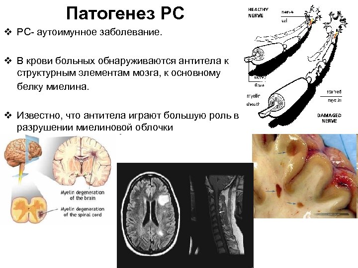 Патогенез РС v РС- аутоимунное заболевание. v В крови больных обнаруживаются антитела к структурным