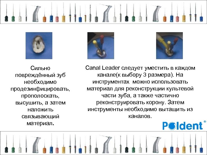 Сильно повреждённый зуб необходимо продезинфицировать, прополоскать, высушить, а затем наложить связывающий материал. Canal Leader