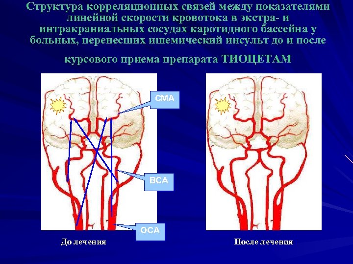 Структура корреляционных связей между показателями линейной скорости кровотока в экстра- и интракраниальных сосудах каротидного