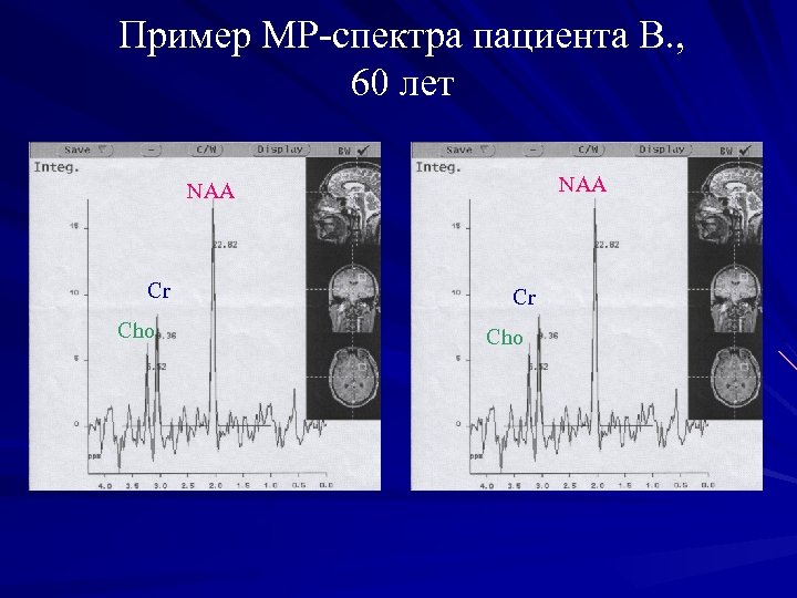Пример МР-спектра пациента В. , 60 лет NAA Cr Cho 