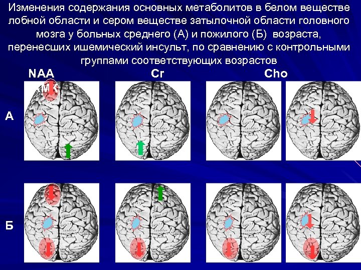 Изменения содержания основных метаболитов в белом веществе лобной области и сером веществе затылочной области