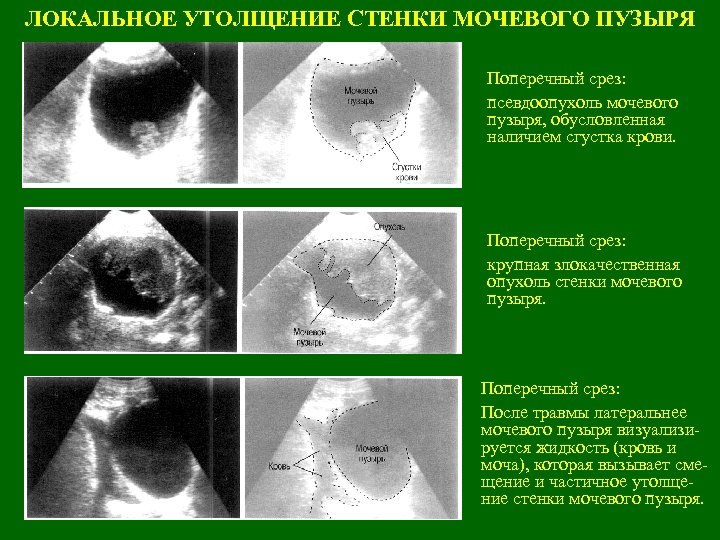 ЛОКАЛЬНОЕ УТОЛЩЕНИЕ СТЕНКИ МОЧЕВОГО ПУЗЫРЯ Поперечный срез: псевдоопухоль мочевого пузыря, обусловленная наличием сгустка крови.
