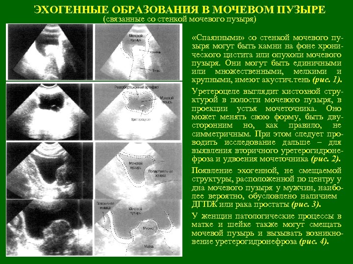 ЭХОГЕННЫЕ ОБРАЗОВАНИЯ В МОЧЕВОМ ПУЗЫРЕ (связанные со стенкой мочевого пузыря) «Спаянными» со стенкой мочевого