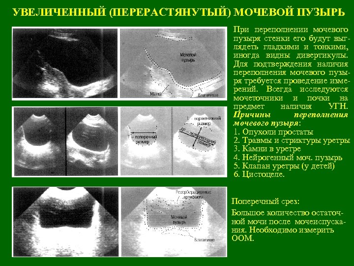 УВЕЛИЧЕННЫЙ (ПЕРЕРАСТЯНУТЫЙ) МОЧЕВОЙ ПУЗЫРЬ При переполнении мочевого пузыря стенки его будут выглядеть гладкими и