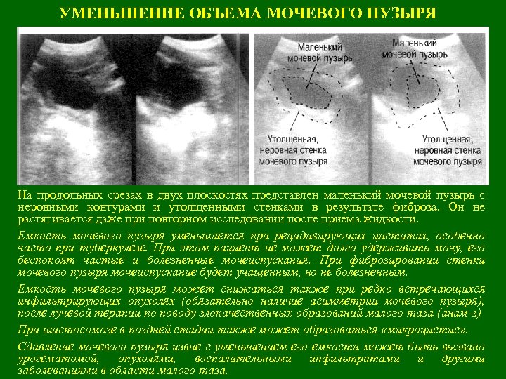 УМЕНЬШЕНИЕ ОБЪЕМА МОЧЕВОГО ПУЗЫРЯ На продольных срезах в двух плоскостях представлен маленький мочевой пузырь