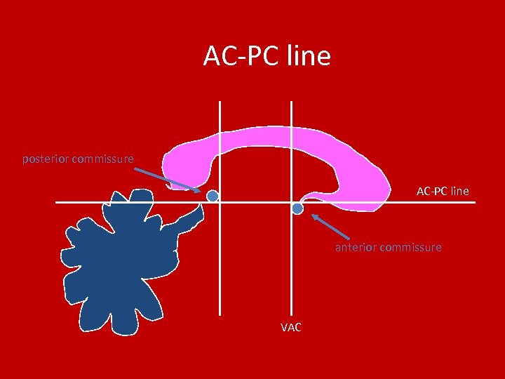 AC-PC line posterior commissure AC-PC line anterior commissure VAC 