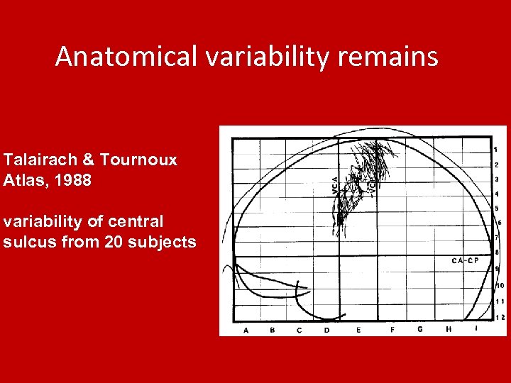 Anatomical variability remains Talairach & Tournoux Atlas, 1988 variability of central sulcus from 20