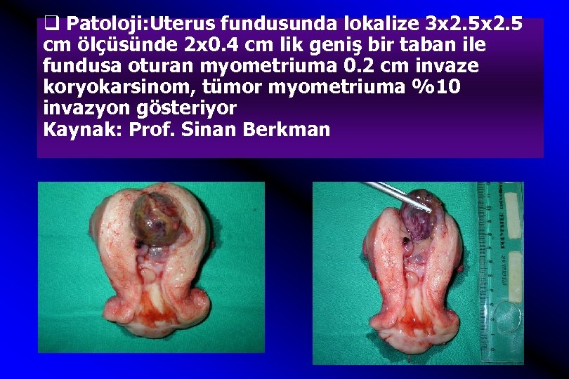q Patoloji: Uterus fundusunda lokalize 3 x 2. 5 cm ölçüsünde 2 x 0.