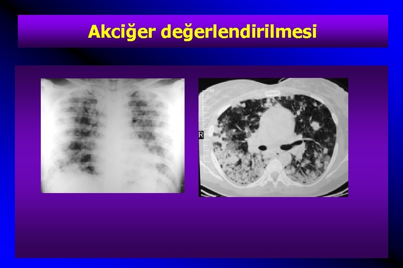 Akciğer değerlendirilmesi 