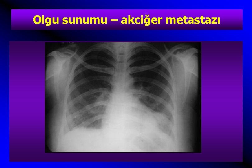 Olgu sunumu – akciğer metastazı 