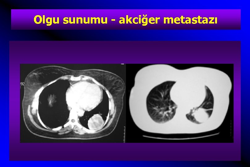 Olgu sunumu - akciğer metastazı 