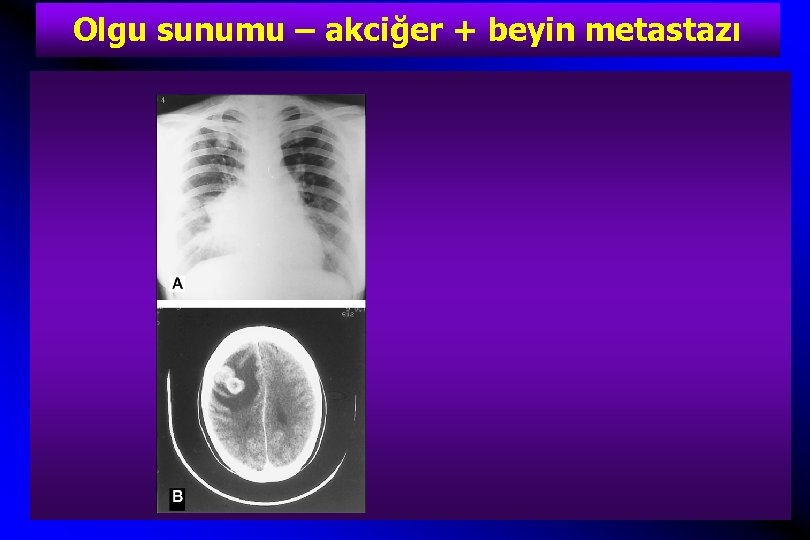 Olgu sunumu – akciğer + beyin metastazı 