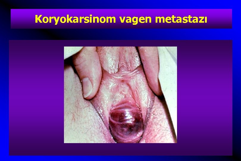 Koryokarsinom vagen metastazı 