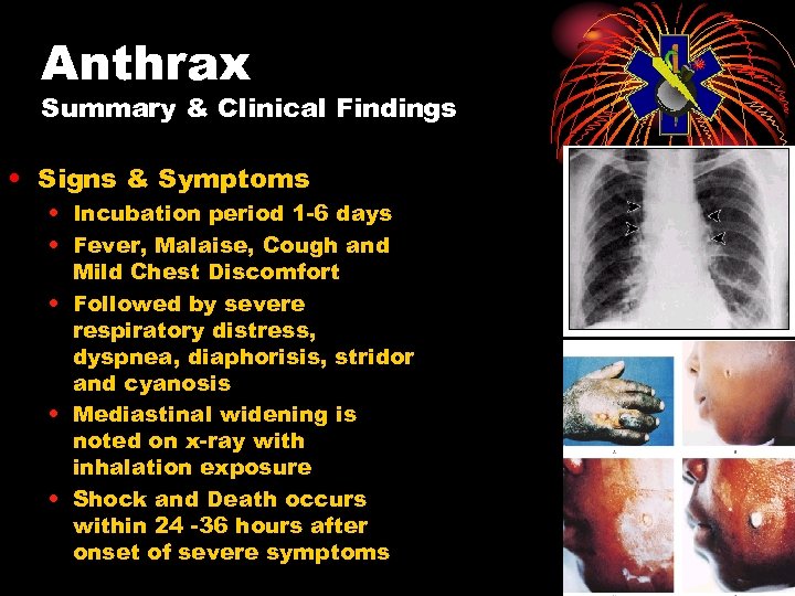 Anthrax Summary & Clinical Findings • Signs & Symptoms • Incubation period 1 -6