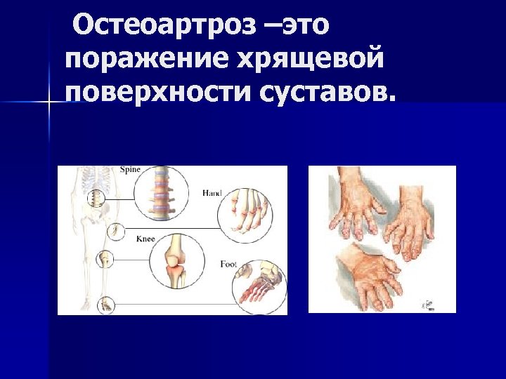  Остеоартроз –это поражение хрящевой поверхности суставов. 