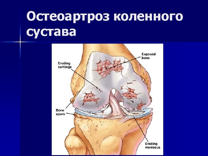 Остеоартроз коленного сустава 