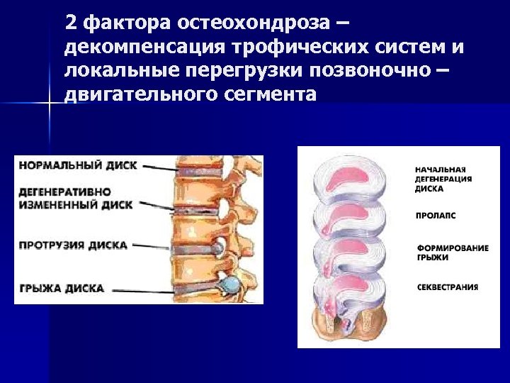 Факторы остеохондроза. Двигательный сегмент позвоночника. Остеохондроз позвоночно-двигательного сегмента. Строение позвоночно двигательного сегмента. Позвоночно двигательный сегмент неврология.