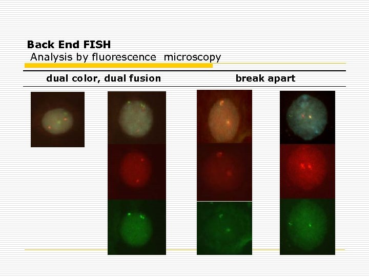 Back End FISH Analysis by fluorescence microscopy dual color, dual fusion break apart 