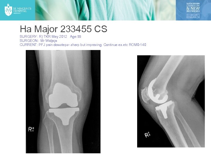 Ha Major 233455 CS SURGERY: R) TKR May 2012 Age: 55 SURGEON: : Mr