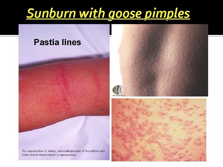 Sunburn with goose pimples Pastia lines 