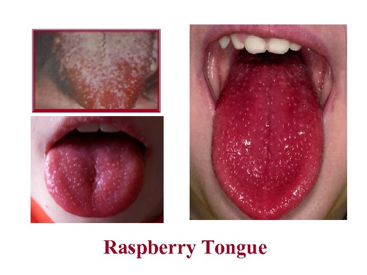 Raspberry Tongue 