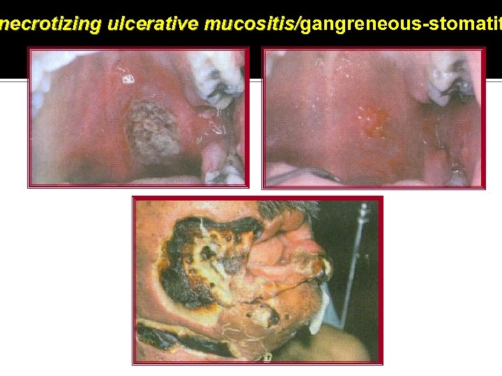 necrotizing ulcerative mucositis/gangreneous-stomatit mucositis/ 