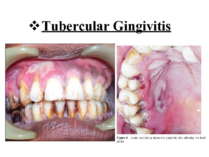 v Tubercular Gingivitis 