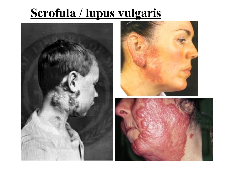 Scrofula / lupus vulgaris 